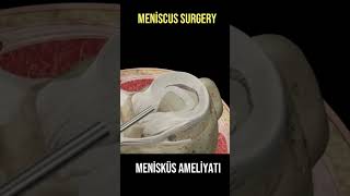 Menisküs Yırtığı Ameliyatı