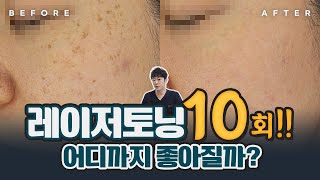 레이저토닝 10회하면 얼마나 좋아질까?