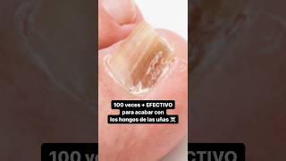 ESTO es 100 veces + EFECTIVO que otros remedios para acabar con los hongos de las uñas ☠️ #skincare