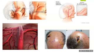 Arteritis de Células Gigantes