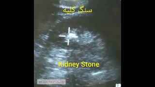 kidney Stone