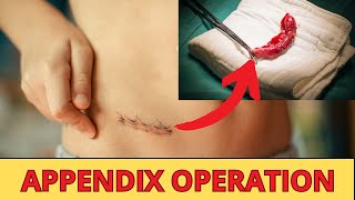 Appendix : Causes, Symptoms And What's  The Benefit Of The Appendix | Appendix Operation.