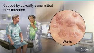 warts psa, anatomy