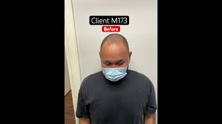 Client m173 before Micro hair tattooing #smp #scalpmicropigmentation #edmonton