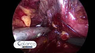 DR CALARCO - Laparoscopic Radical Prostatectomy   Dr  Alessandro Calarco 1:4