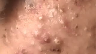 Huge Acne Pimples Blackheads Popping Up Satisfying with Oddly Calm Music