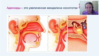 Вебинар лор-врач об аденоидах