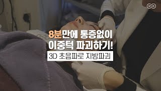 튠레이저편 - 8분만에 이중턱 파괴하기 [MH클리닉]