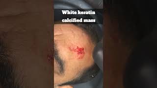 Sebaceous cyst removal forehead @DrArifMDDermatologist