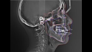 WillCeph- Automated Cephalometric Analysis Software