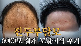 [Mobien TV] 20대 남성 전두부 모발이식 절개 6000모 10개월 경과 #광주탈모치료 #전남모발이식