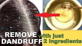 Dandruff रूसी को हमेशा के लिए जड़ से खत्म करने के घरेलु नुस्खे | Get Rid Of Dandruff Permanently