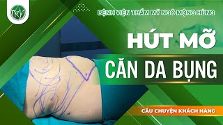 Hút Mỡ, Căng Da Bụng | Bác Sĩ Ngô Mộng Hùng #ngomonghung