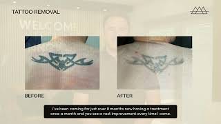 Are you looking to remove an old tattoo?