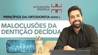 MALUCLUSÕES DA DENTIÇÃO DECÍDUA - Princípios da Ortodontia - Parte 6