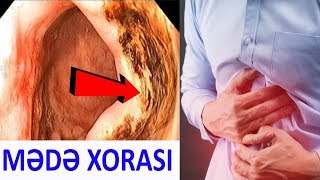 DİQQƏT! Mədə xorası sizi ölümə aparır