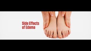 What Are The Side Effects and Complications of Edema?