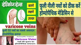 Varicose Vein Best Homoeopathic Medicine To Avoid Surgery//वेरिकोस वेन्स की अचूक होमीयोपेथिकदवायें .