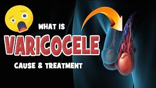 What is Varicocele? - Cause & Treatment