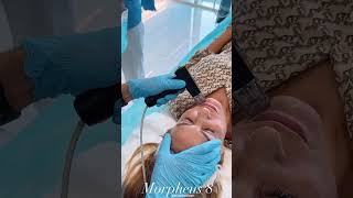 Morpheus 8 Treatment in Dubai | Skin Tightening, Anti-Aging, and Rejuvenation