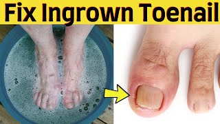 How to fix ingrown toenail permanentlyyourself overnight at home