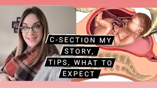 C-section, what to expect, My story & TIPS.