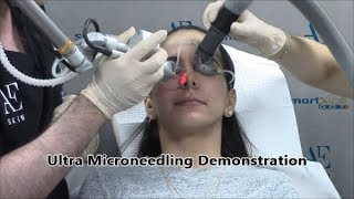 Ultra Microneedling Demonstration 13 - A E Skin - Encino, CA - 818-835-1833