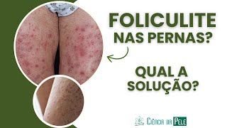 Foliculite nas Pernas: Principais Causas e Soluções