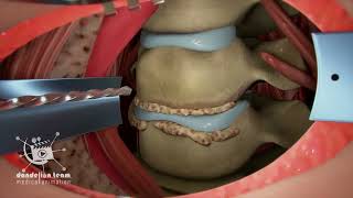 Neck Treatment|Cervical Discectomy|disk replacement in the C6-C7 disk using an implant-a new method