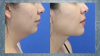 Best doctor for neck lipo Beverly Hills - Dr. Dennis Dass