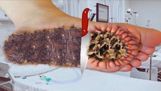 Relaxing & Satisfying Chin Ingrown legs & Pimple Removal | ASMR Animation!: