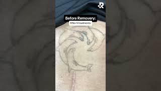 Before & After Tattoo Removal😍