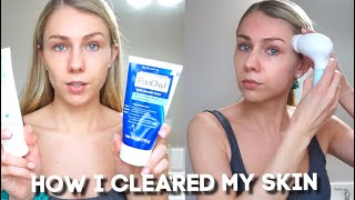 How I Cleared My Skin & My Must Have Skin Care Products 💕