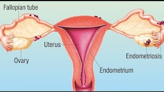 Endometriosis Cyst/ Chocolate Cyst Detail in Urdu