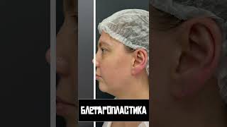 До и после блефаропластики #блефаропластика #допосле #операция