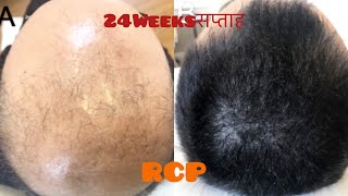 NATURAL|Hair fall|Treatment|Solution|RCP|Results|Minoxidil|Finasteride|hindi|regrow|Hair transplant