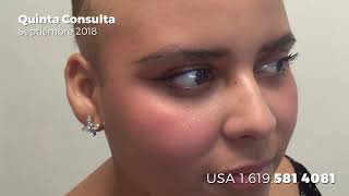 ALOPECIA UNIVERSALIS CURING WITH ANTIBIOTICS