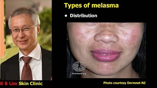 Melasma (Chloasma)