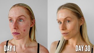 I tried to Get Glass Skin in 30 Days *as a compulsive skin picker*