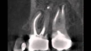 Cone Beam CT shows lesion on upper molar