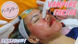 VAMPIRE FACIAL (GOODBYE SCARS?) session#1| PRETTYDOSE | DAVAO