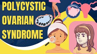 Polycystic Ovarian Syndrome (PCOS): Symptoms, Causes, Diagnosis and Treatment