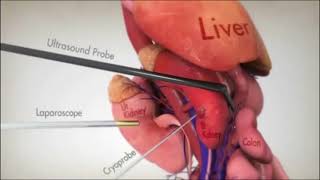 Crioablación en cáncer de riñón