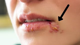 How to get rid of Cold Sores | Oral Herpes Naturally Forever at Home - 4 Natural Home Remedies