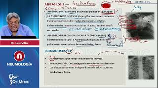 2024 NEUMOLOGÍA   Micosis pulmonares  Neumocistosis