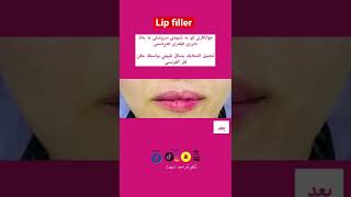 Lip filler.#fillerlips #filler