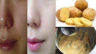 आलू से कैसे करे फैशियल - How to Do Potato Facial To Get Instant Glowing Skin - Skin Whitening Facial