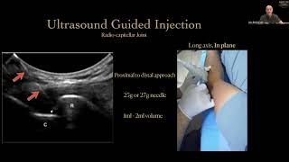 Elbow ultrasound and regenerative medicine tips.. Platelet rich plasma and  stem cells.