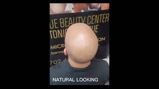 SCALP MICROPIGMENTATION TESTIMONIAL  / INSANE TRANSFORMATION  FOR THIS GENTLEMAN