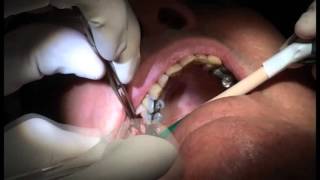 The Platelet Rich Fibrin Internal Sinus Lift Video!!